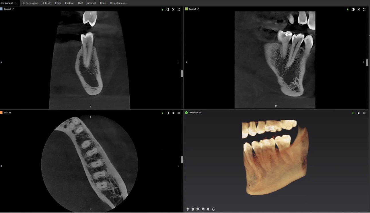 2D slices from CBCT scan